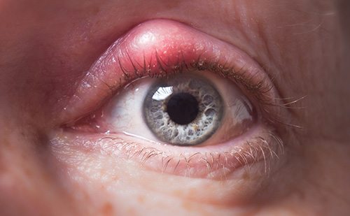 Types and Causes of Blepharitis