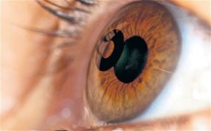 Presbyopia Treatment