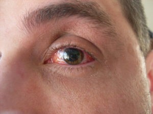 Lattice degeneration eye disease