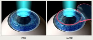 Types of laser vision correction