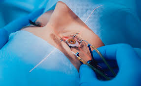 Cataract surgery treatment