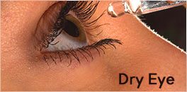 Dry Eye