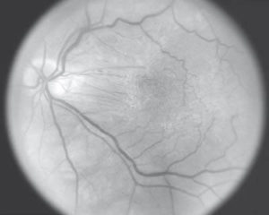 Macular Puckers