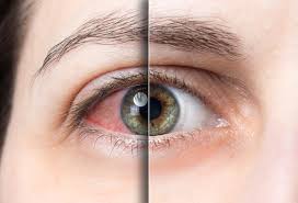 What is Ocular surface disease?