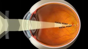 What is a Refractive Error?