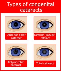 Cataract Types