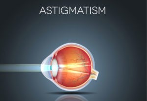 Astigmatism
