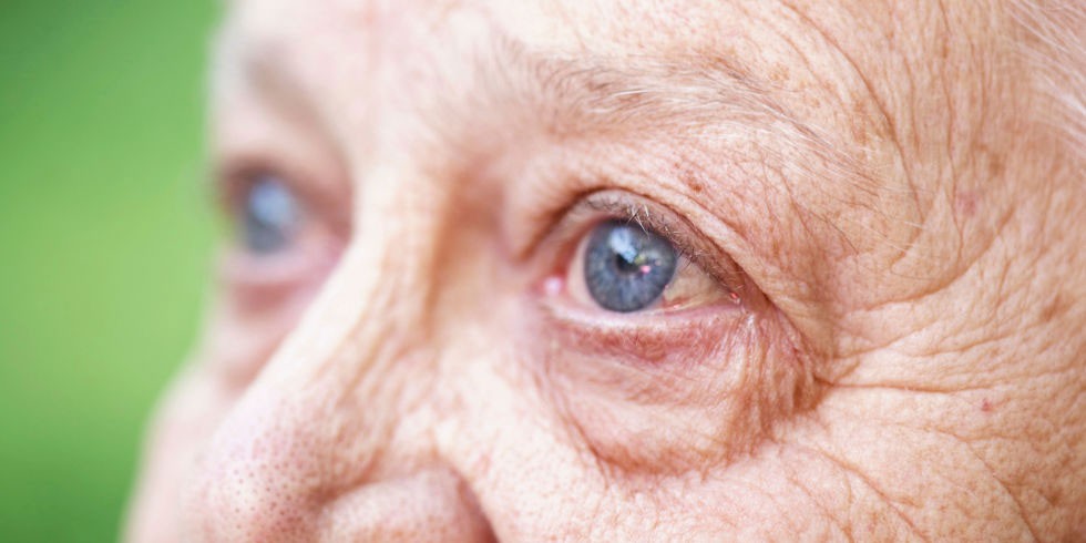 Age related macular degeneration Macular degeneration