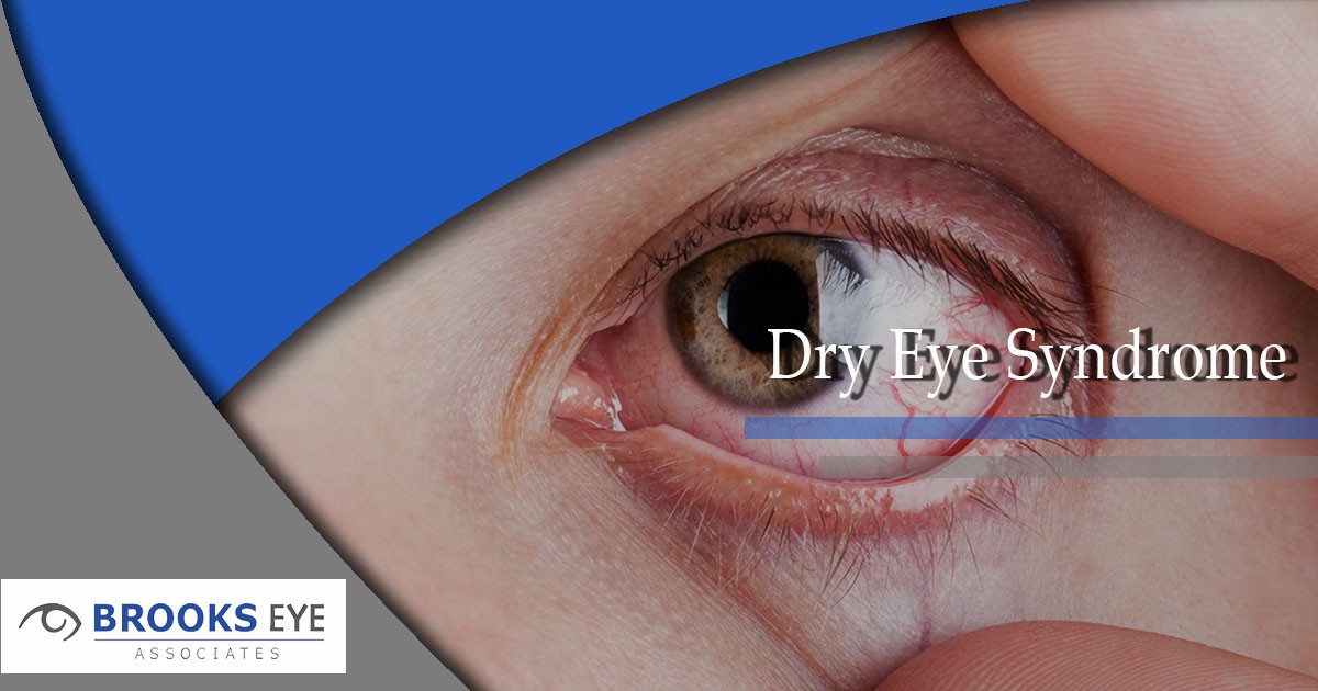 What is Dry Eye Syndrome? Brooks Eye Associates