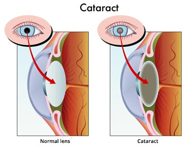 What are Cataracts?