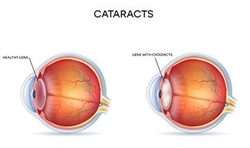 What are Cataracts?