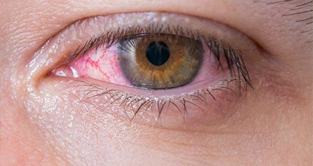 Red Irritated Eye