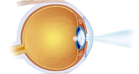 Refractive Disorders at Brooks Eye Associates 