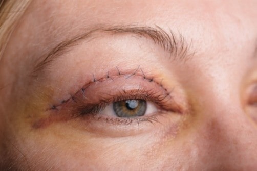 Blepharoplasty Performed