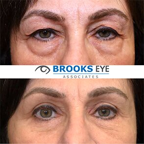 upper and lower blepharoplasty female before and after