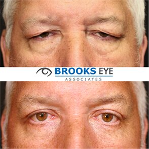upper and lower blepharoplasty male before and after
