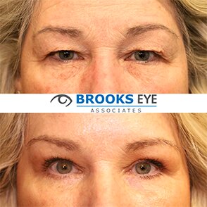 upper and lower blepharoplasty with botox before and after