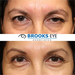 upper blepharoplasty before and after