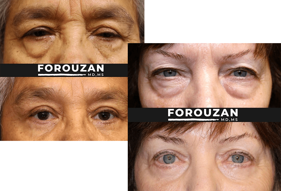 patient of Dr. Forouzan before and after at Brooks Eye Associates